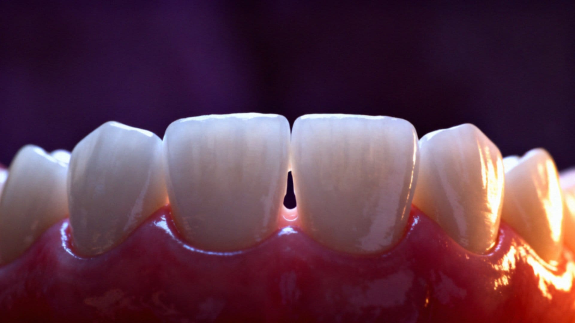 Diastema co to jest? Przyczyny, rodzaje i leczenie przerwy między zębami